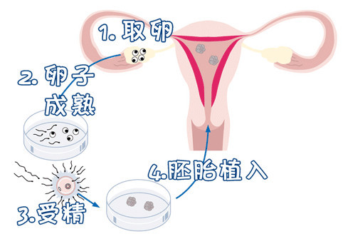 北京助孕包成功服务